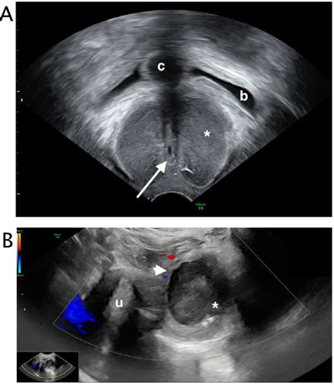 inflammation glande de skene|Skene’s Gland Abscess: Detection With Transperineal。